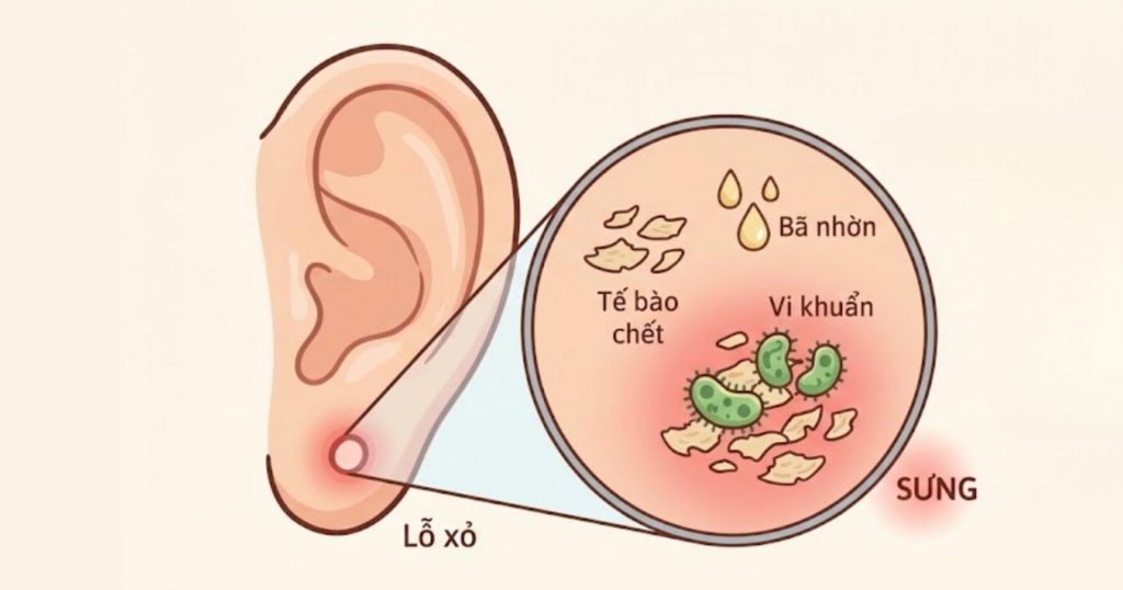 lâu ngày không đeo khuyên tai bị sưng