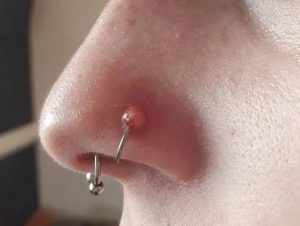 Sẹo lồi xỏ khuyên