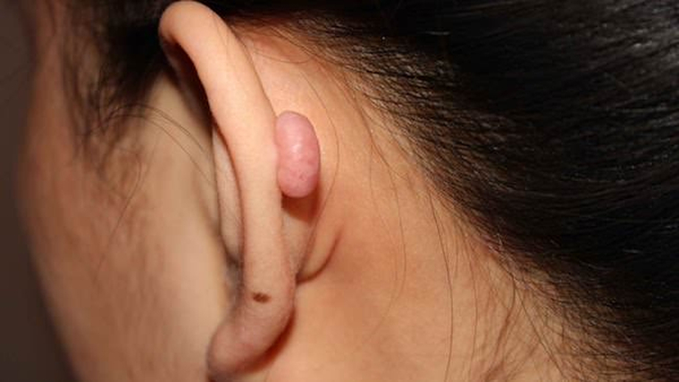 Sẹo lồi xỏ khuyên không nguy hiểm đến tính mạng nhưng ảnh hưởng đến thẩm mỹ