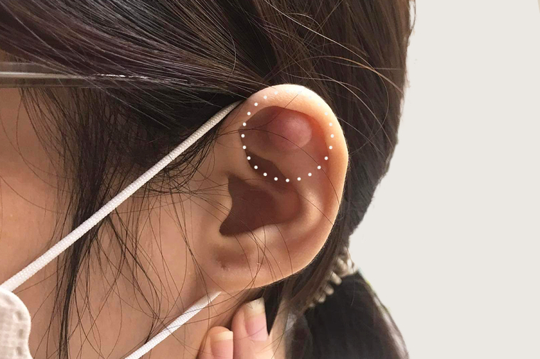 Khi có dấu hiệu bất thường như bump, cần liên hệ với cơ sở xỏ/bấm khuyên hoặc các cơ sở y tế để được tư vấn và hỗ trợ